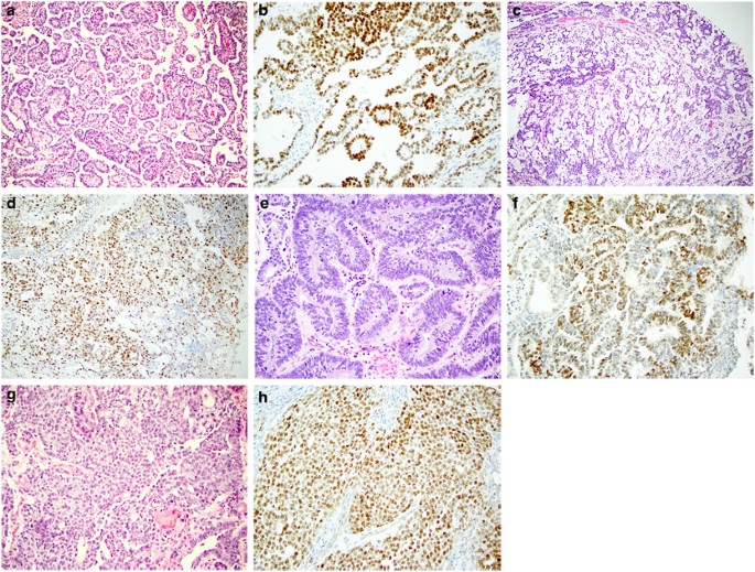 ZBTB16: a novel sensitive and specific biomarker for yolk sac tumor |  Modern Pathology
