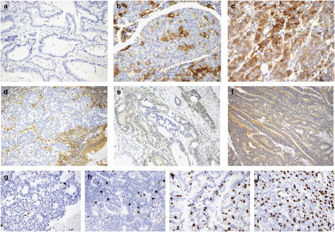 PD-L1 expression in colorectal cancer is associated with microsatellite  instability, BRAF mutation, medullary morphology and cytotoxic tumor-infiltrating  lymphocytes | Modern Pathology
