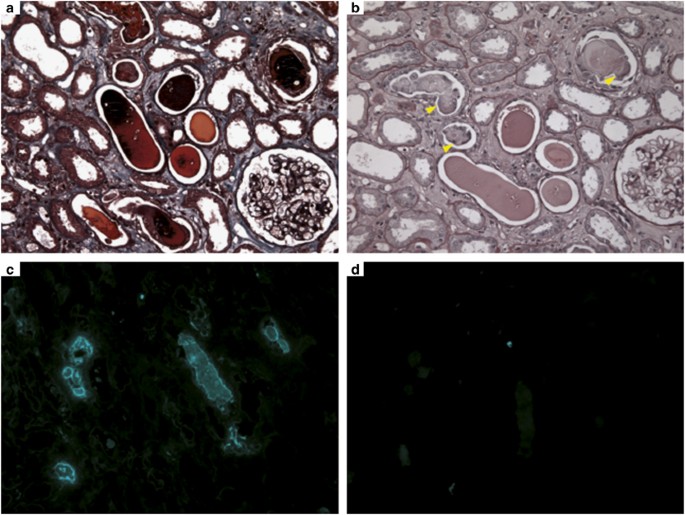 Intratubular Amyloid In Light Chain Cast Nephropathy Is A Risk Factor For Systemic Light Chain Amyloidosis Modern Pathology