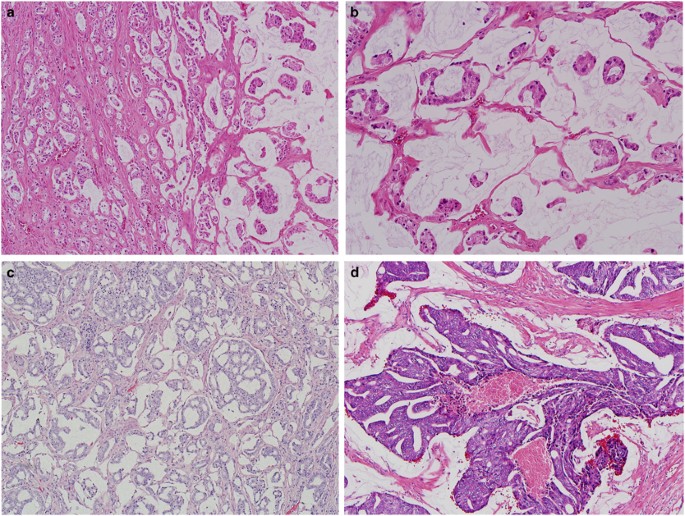 Cancerul Prostatei | Centru Oncologie Severin