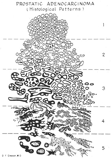 adenocarcinoma prostate gleason 6( 33)