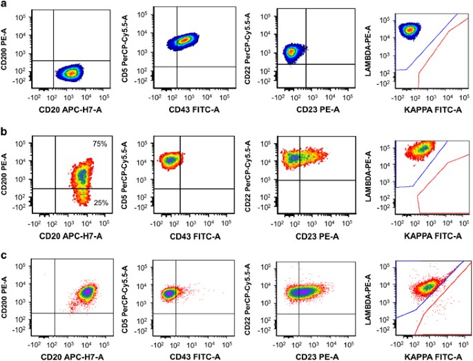 Cd0 Expression In Mantle Cell Lymphoma Identifies A Unique Subgroup Of Patients With Frequent Ighv Mutations Absence Of Sox11 Expression And An Indolent Clinical Course Modern Pathology