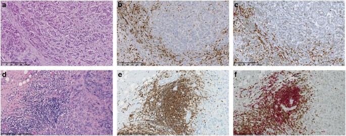 Reliability of tumor-infiltrating lymphocyte and tertiary lymphoid  structure assessment in human breast cancer | Modern Pathology
