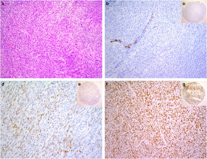 Loss of H3K27 trimethylation is not suitable for distinguishing malignant peripheral  nerve sheath tumor from melanoma: a study of 387 cases including mimicking  lesions