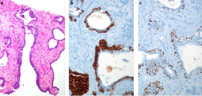 Diagnostic Utility Of A P63 A Methyl Coa Racemase P504s Cocktail In Atypical Foci In The Prostate Modern Pathology