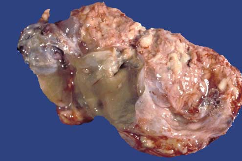 Eight patients with borderline tumour who developed recurrence