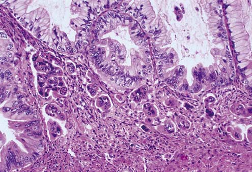 Clinicopathological Characteristics and Prognosis of 91 Patients with  Seromucinous and Mucinous Borderline Ovarian Tumors: a Comparative Study