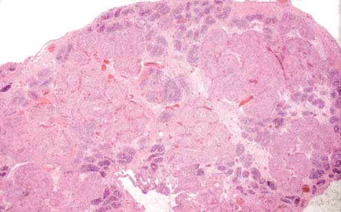 Sex cord-stromal tumors of the ovary and testis: their similarities and