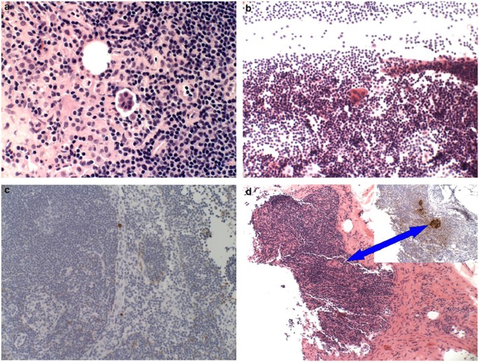 breast ectomy with sentinel node biopsy breast ectomy with sentinel node biopsy