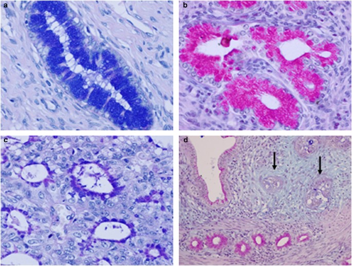 Endocervical adenocarcinomas associated with lobular endocervical glandular  hyperplasia: a report of four cases with histochemical and  immunohistochemical analyses