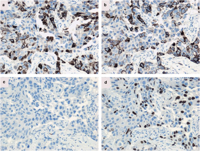 Cytokeratin 5 14 Positive Breast Cancer True Basal Phenotype Confined To Brca1 Tumors Modern Pathology
