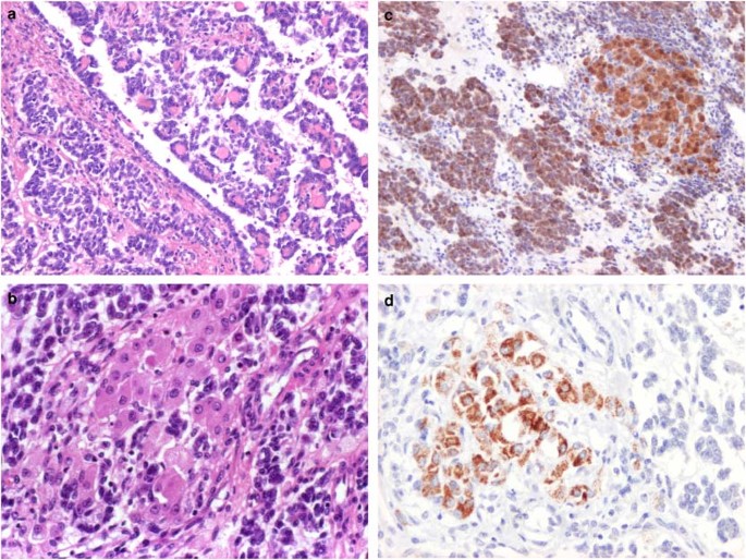 Uterine tumors resembling ovarian sex cord tumors are polyphenotypic neoplasms with true sex cord differentiation