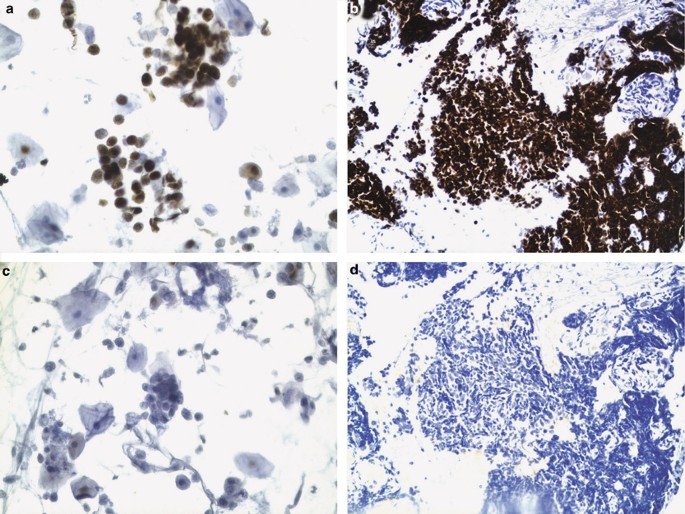TTF-1 and p63 for distinguishing pulmonary small-cell carcinoma from poorly  differentiated squamous cell carcinoma in previously pap-stained cytologic  material | Modern Pathology