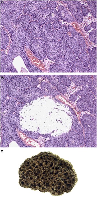 Inverted urothelial papilloma pathology, Urinary bladder inverted papilloma