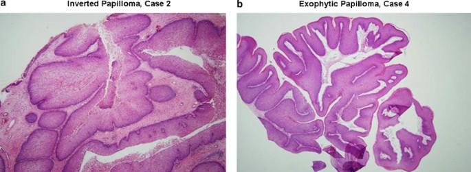 sinonasal papilloma