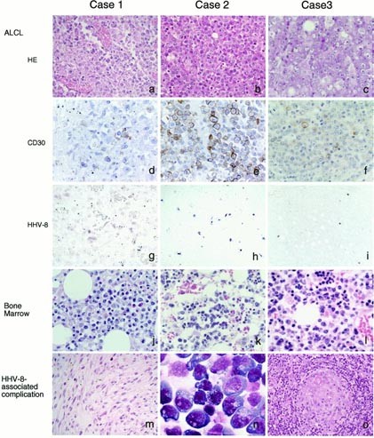Human Herpesvirus 8 Associated Solid Lymphomas That Occur In Aids Patients Take Anaplastic Large Cell Morphology Modern Pathology