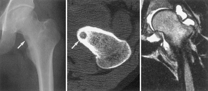 Intraarticular Osteoid Osteoma Associated With Synovitis A Possible Role Of Cyclooxygenase 2 Expression By Osteoblasts In The Nidus Modern Pathology