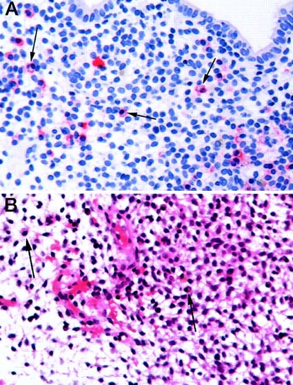 Plasma cells in chronic endometritis are easily identified when stained with syndecan-1