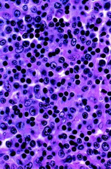 Posttransplant Lymphoproliferative Disorders in Lung Transplant Patients: The Cleveland Clinic Experience
