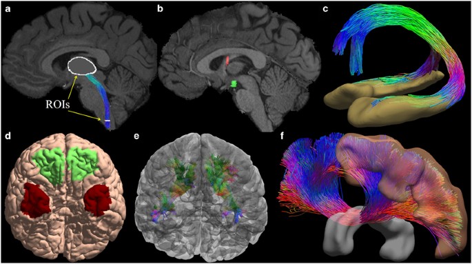 Measuring Connectivity in the Primary Visual Pathway in Human Albinism  Using Diffusion Tensor Imaging and Tractography