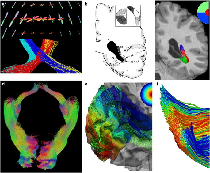 Measuring Connectivity in the Primary Visual Pathway in Human Albinism  Using Diffusion Tensor Imaging and Tractography