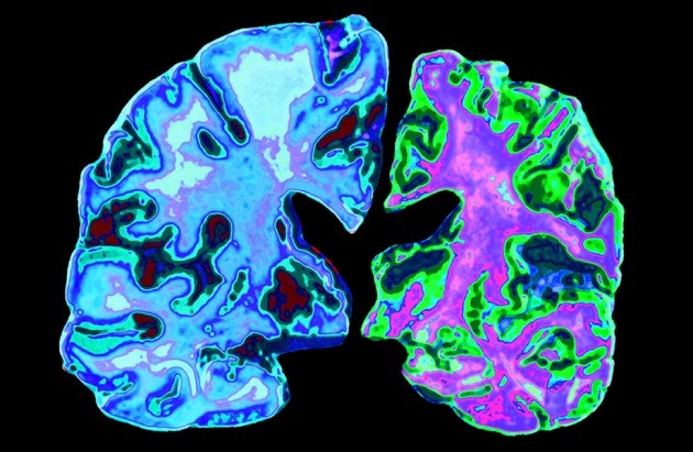 Leading Alzheimer’s theory survives drug failure