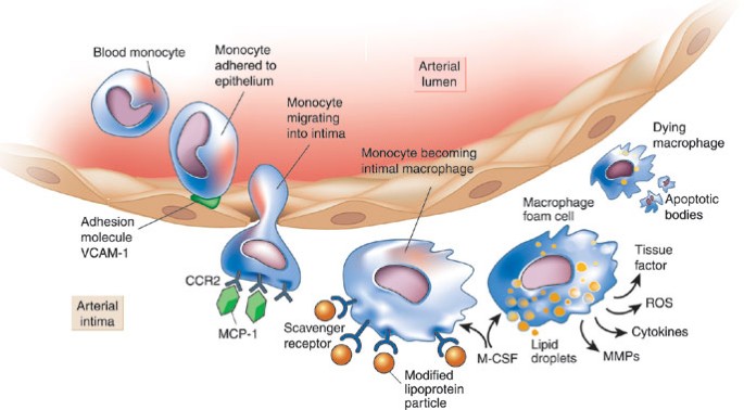 Inflammation in atherosclerosis | Nature Inflammation in atherosclerosis | Nature
