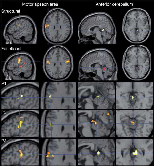 Teens' IQs can rise (or fall), thanks to changes in the brain