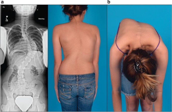 A PAX1 enhancer locus is associated with susceptibility to idiopathic  scoliosis in females | Nature Communications