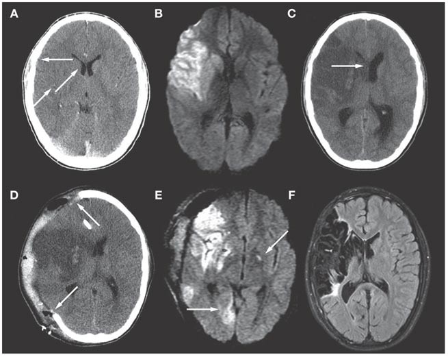 Ischemic stroke complicating pediatric cardiovascular disease