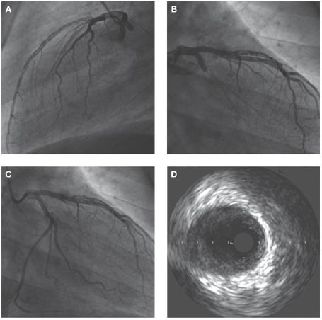 Antiphospholipid antibodies from a patient with primary antiphospholipid syndrome enhance experimental atherosclerosis