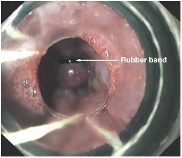rubber band ligation