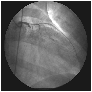Coronary artery disease in patients with systemic lupus erythematosus