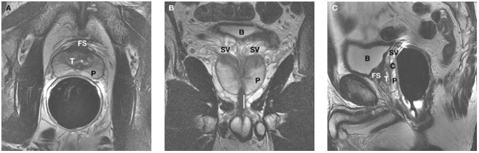 Prostate mri radiographics 2021