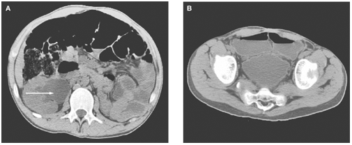 Ureterosigmoidostomy and obstructive uropathy | Nature Reviews Urology