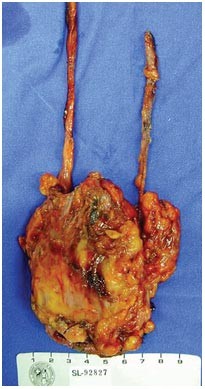 Management of panurothelial disease in superficial bladder cancer