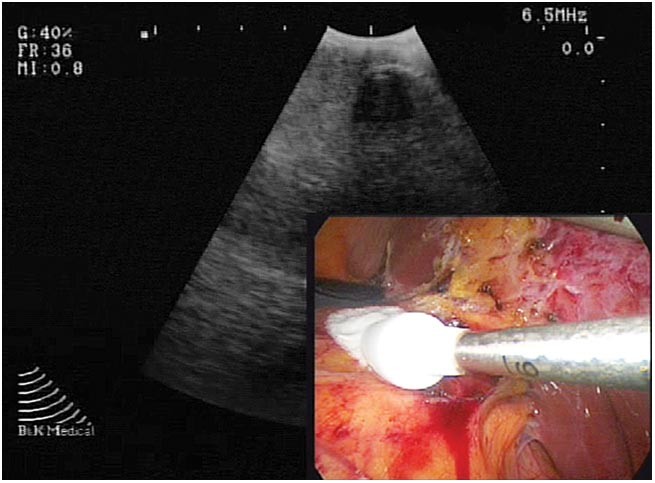 Ablative techniques for the management of kidney cancer