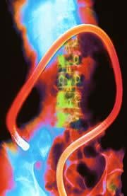 Protein points to risk of colon cancer
