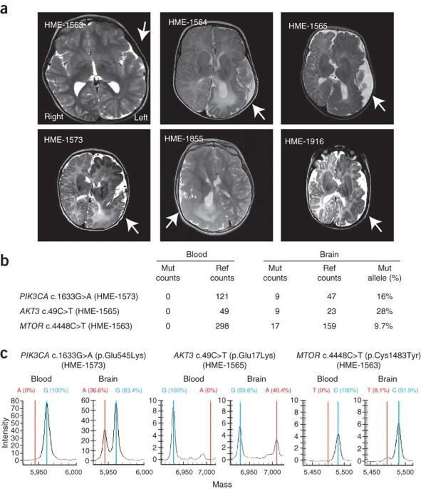 De Novo Somatic Mutations In Components Of The Pi3k Akt3 Mtor Pathway Cause Hemimegalencephaly Nature Genetics