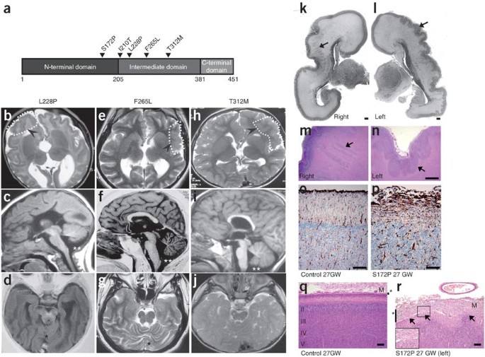 Mutations In The B Tubulin Gene Tubb2b Result In Asymmetrical Polymicrogyria Nature Genetics
