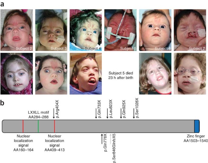 De novo nonsense mutations in ASXL1 cause Bohring-Opitz syndrome | Nature  Genetics