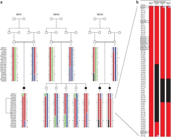 Mutations in glis3 are responsible for a rare syndrome with neonatal diabetes mellitus and congenital hypothyroidism