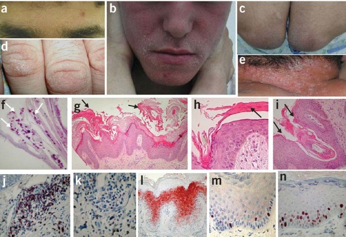 Dermatitis seborreica - ScienceDirect