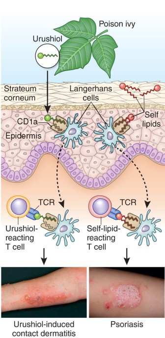 Cracking The Code Of Skin Inflammation With Cd1a Nature Immunology