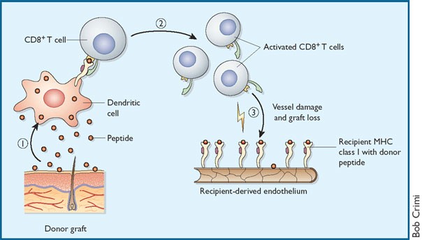 Transplantation—caught in the crossfire!