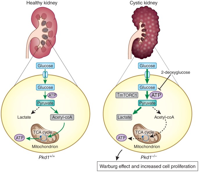 semaglutide polycystic kidney disease Metabolic reprogramming in polycystic kidney disease