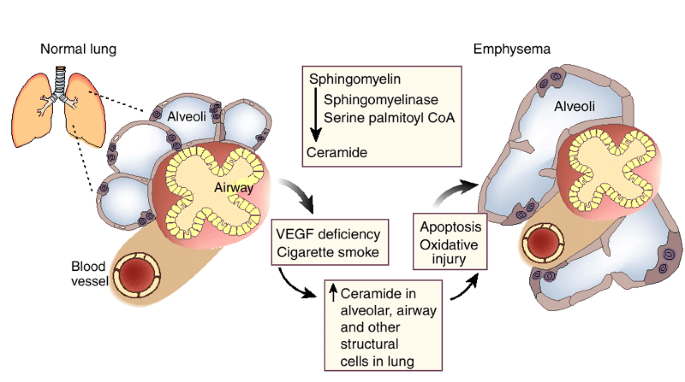 Lipid let loose in pulmonary emphysema