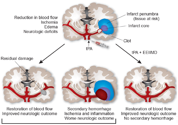 Tpa clot buster