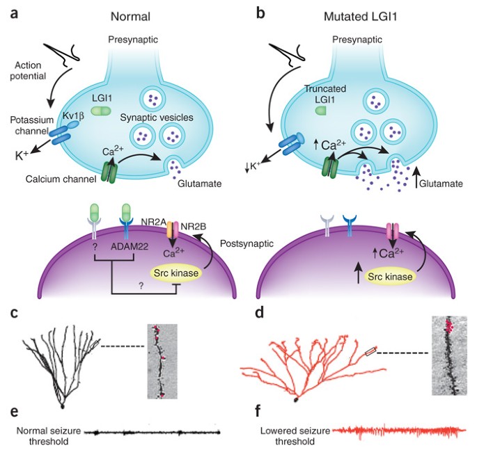 Epilepsy: synapses stuck in childhood