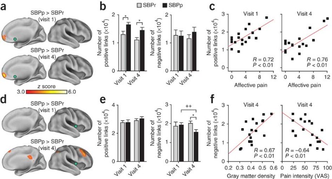 Corticostriatal circuits in the transition to chronic back pain: The  predictive role of reward learning - ScienceDirect